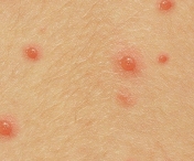 Cazurile de varicela se mentin la un nivel crescut in Timis