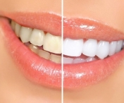 Cui este contraindicata albirea dentara?
