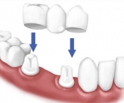 Care sunt contraindicatiile coroanelor dentare?