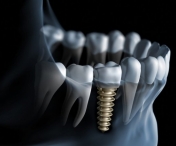 Riscurile implantului dentar