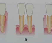 Cum se face tratamentul parodontozei, boala care evolueaza incet si ne lasa fara dinti