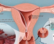 Simptome ale cancerului ovarian pe care FEMEILE nu le baga in seama