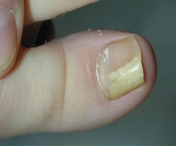 Iata cum prepari un amestec natural care vindeca rapid infectiile unghiilor!