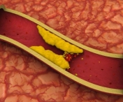 Scapa de colesterol fara sa iei pastile - La analize se va vedea diferenta