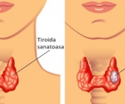 Pentru o glanda tiroida sanatoasa trebuie neaparat sa eviti sa…