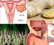 Acesta este modul in care ghimbirul distruge cancerul ovarian, de prostata si colon mai bine decat chimioterapia