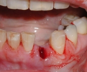 Ce trebuie sa faci dupa extractia dentara