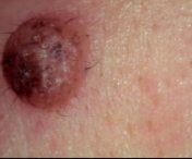Primele simptome ale cancerului de piele