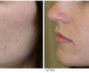 Metode eficiente de a trata cicatricele lasate de acnee