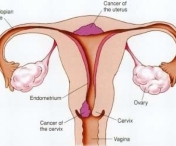 Sangerarile vaginale si durerile pelvine, primele simptome ale cancerului cervical