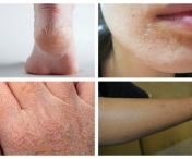 Care sunt cauzele pielii uscate?