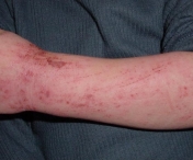 Principalii 10 alergeni care produc dermatite