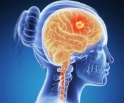 Simptomele care anunta cele mai frecvente tumori in creier