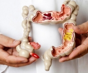 Din ce cauze apare cancerul de colon sau rect?