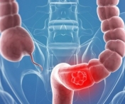 De ce nitritii si nitratii sunt cauze importante ale cancerelor de colon?