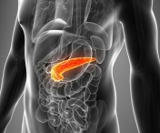 Este cel mai agresiv dintre cancerele digestive: simptomele nu sunt specifice si apar tarziu in evolutia bolii