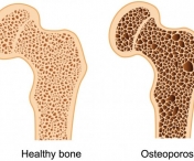 6 mituri despre osteoporoza pe care le credeai si tu