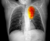 Simptomele cancerului pulmonar sunt adesea confundate cu o raceala