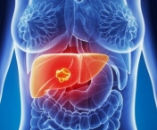 Care sunt cauzele cancerului de ficat?