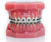DentoCare anunță promoții la aparate dentare