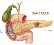 Primele semne ca suferi de pancreatita
