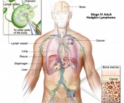 Cum recunoastem cancerul sistemului limfatic