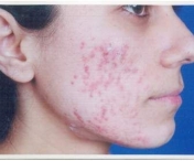 Solutie fabuloasa de tratare a acneei