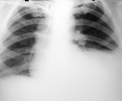 Prin ce difera metastaza pulmonara de cancerul la plamani si in ce consta tratamentul minim invaziv