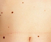 Trebuie neaparat sa stii asta: Care este legatura dintre alunite si cancerul de piele