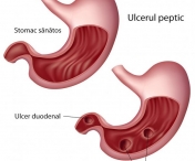 Ce trebuie sa stii despre ulcerul peptic