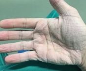 FOTO I Imagine socanta cu mana unui medic după interventii de 12 ore