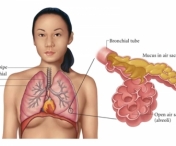 Metode de a evita imbolnavirea de pneumonie