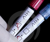 HIV - Tot ce trebuie sa stii despre o boala cumplita: cauze, simptome, transmitere, manifestari