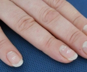 V-ati intrebat vreodata ce sunt petele albe de pe unghii? Acestea pot ascunde boli grave