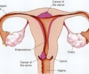 Toate femeile trebuie sa stie acest leac uimitor: Ceaiul care UCIDE cancerul la ovare