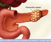 Cancerul pancreatic poate fi depistat in faza incipienta