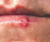 Cea mai frecventa cauza a herpesului