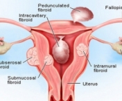 Fara pastile si fara a ajunge la cutit: remediu naturist foarte bun pentru fibrom uterin