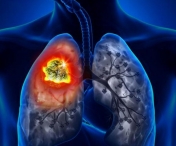 Tratamente personalizate pentru cancerul pulmonar, la OncoHelp, pentru toate fazele de boala